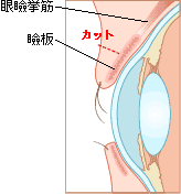 眼瞼下垂