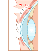 眼瞼下垂