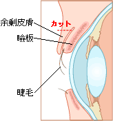 睫毛内皮症(さかさまつげ)