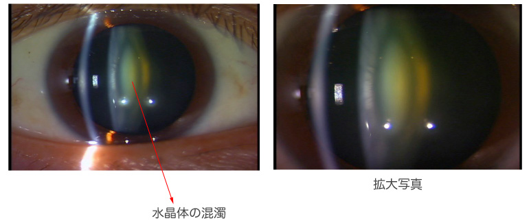 白内障の一例