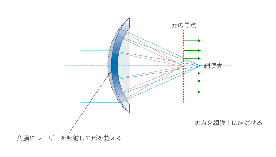 レーシックの原理