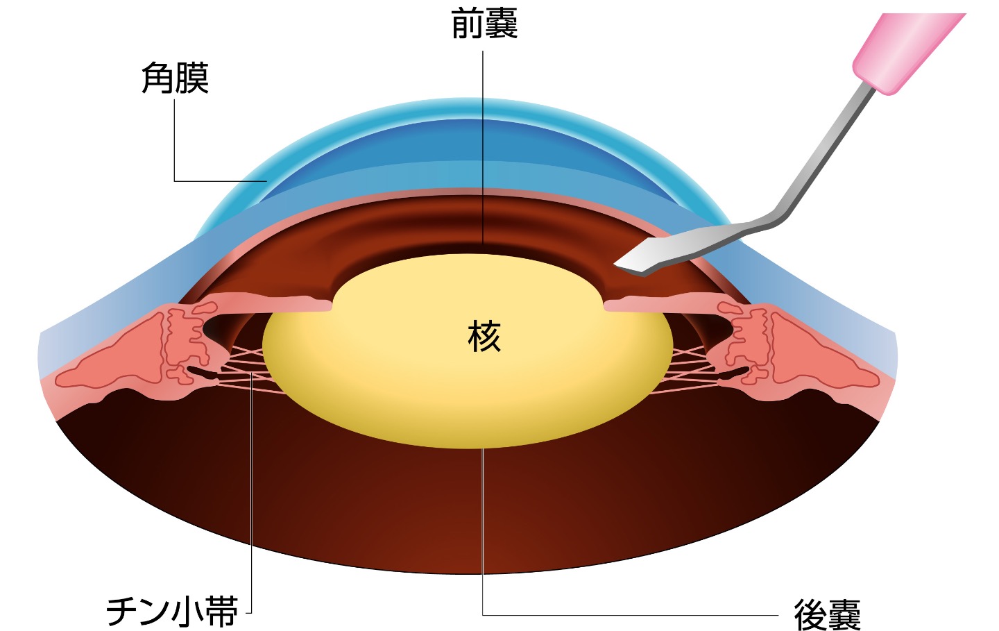 手術手順