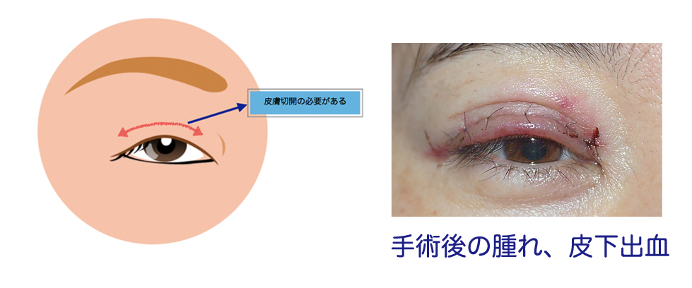 従来の眼瞼下垂に対する手術